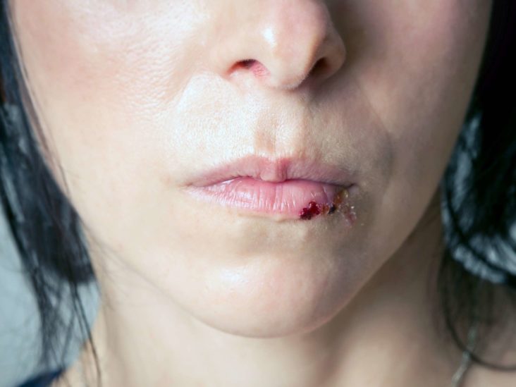 How To Heal Cut Inside Lip Heal Info