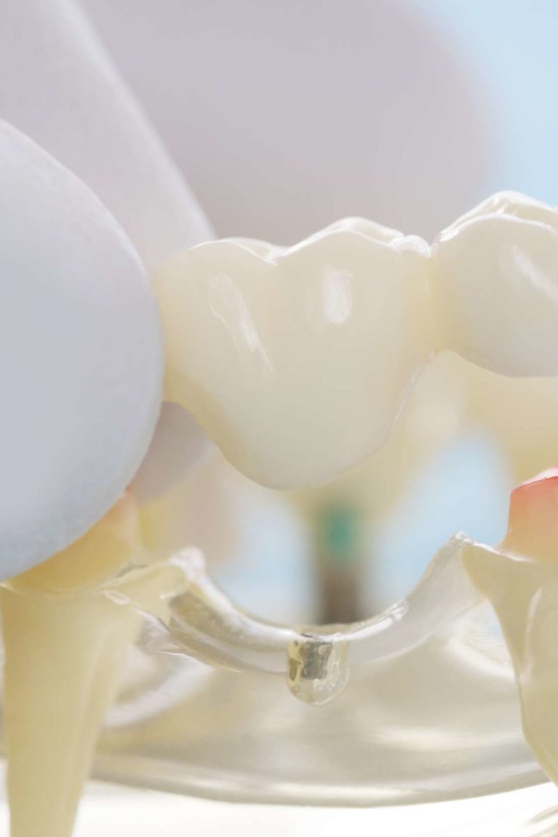What is a Temporary Dental Bridge: Everything You Need to Know
