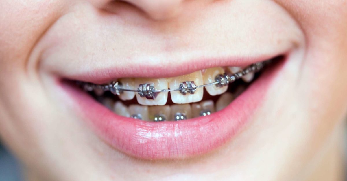 Braces while wearing swollen gums 5 Reasons