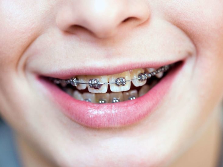 Do Braces Hurt What To Expect When You Get Braces