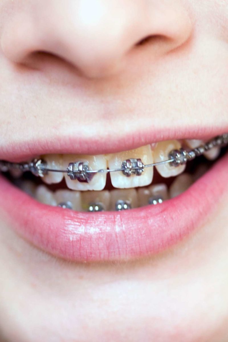 Do Braces Hurt? What To Expect When You Get Braces