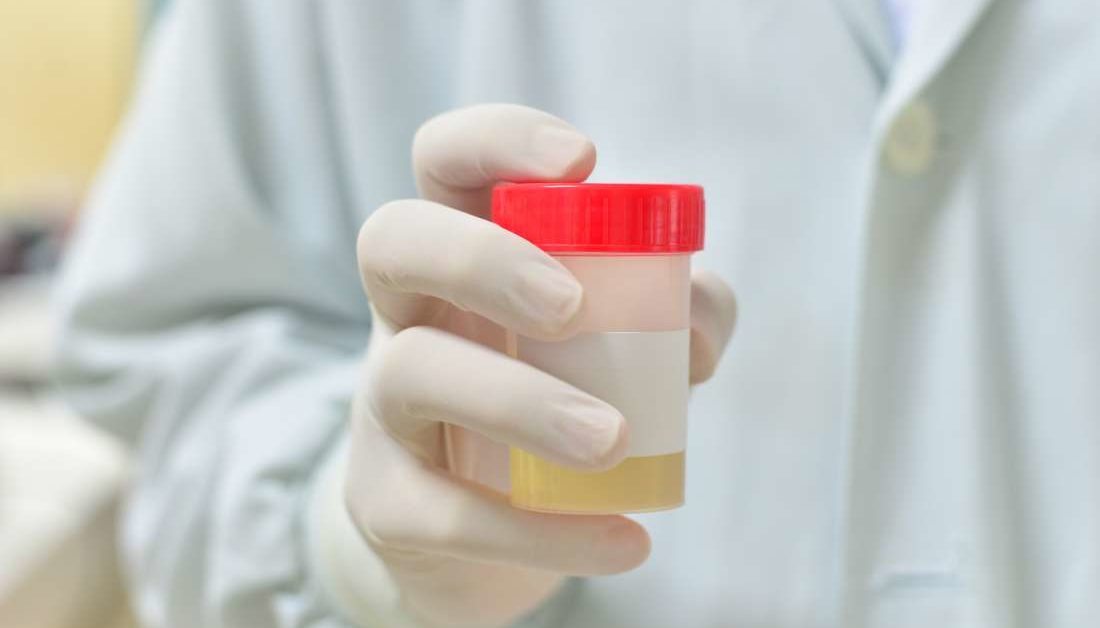 can a urine test detect prostate problems