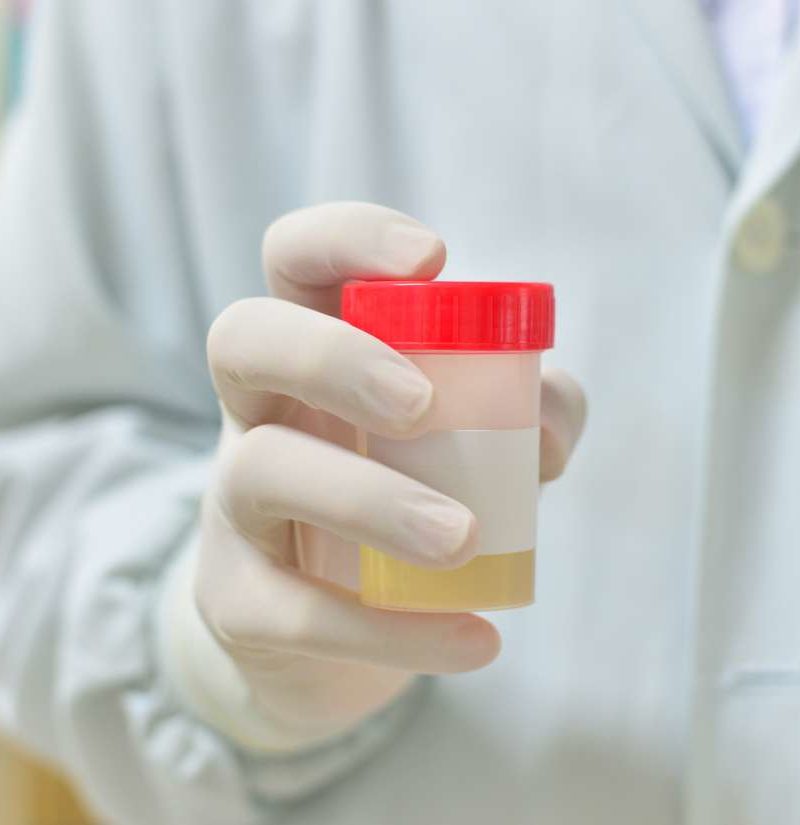 prostate cancer urine test results)