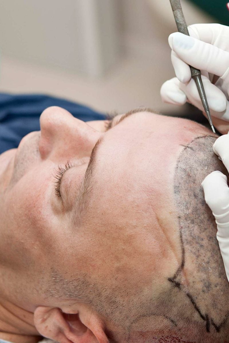 Toronto FUE (Follicular Unit Extraction) Hair Transplant
