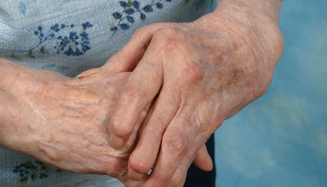 Artritis las manos: Síntomas, tratamiento remedios caseros