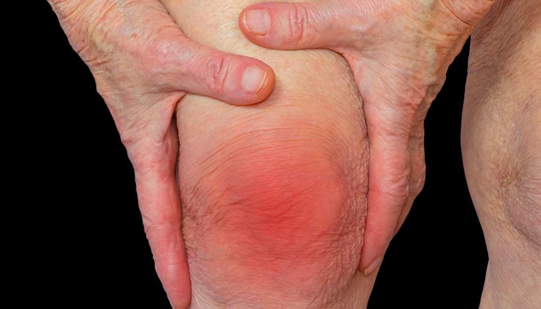 Sintomas artritis reumatoide y fibromialgia