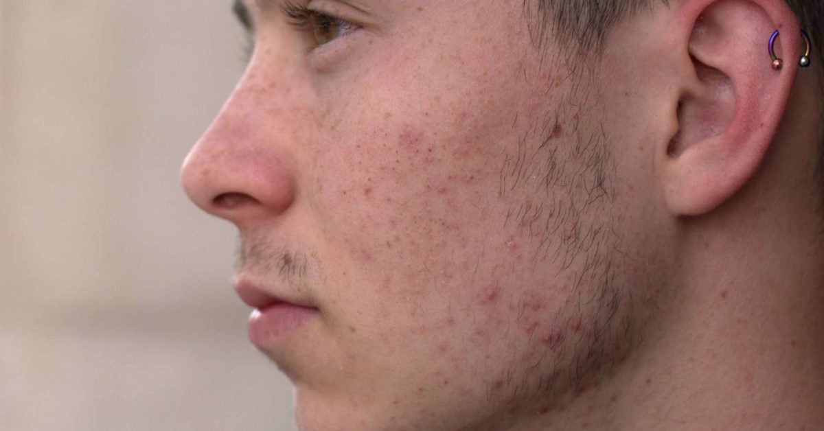 Masturbation, acne, and pimples: What's the link?