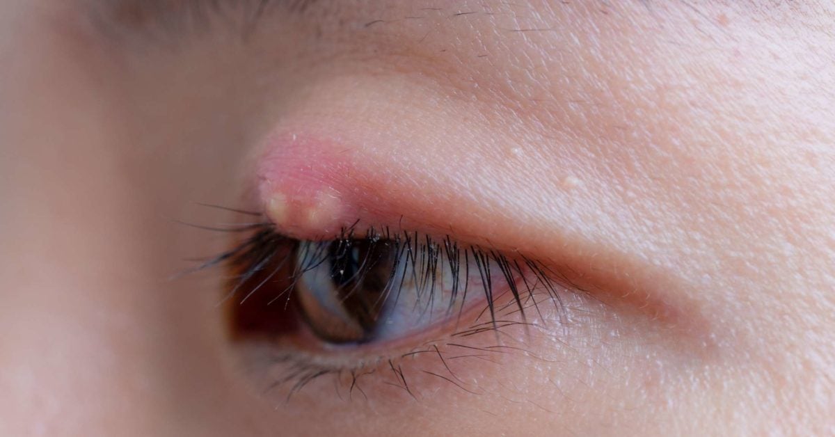 7 Ways To Treat Or Get Rid Of A Stye
