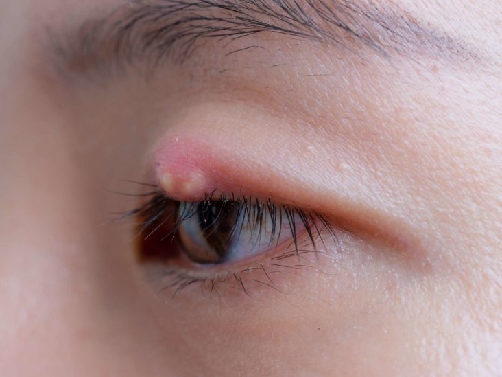What causes styes, and how to get rid of them