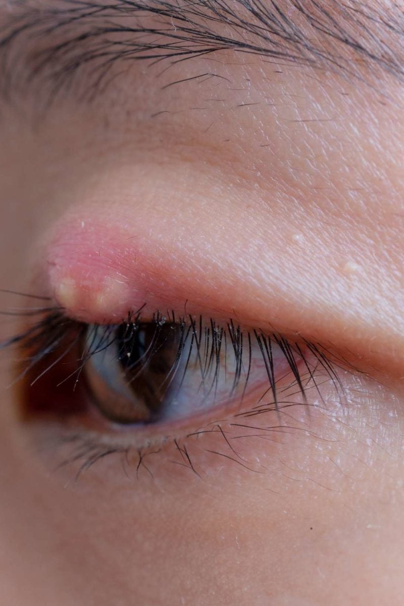 How to Get Rid of an Infected Eyelash 