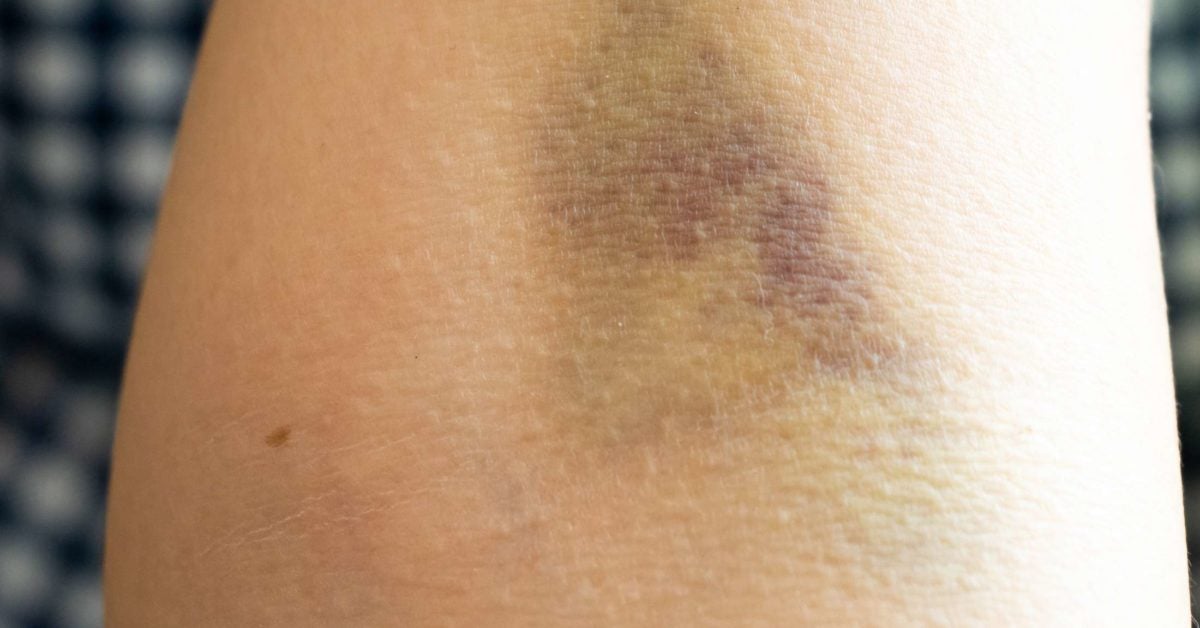 Bruising after a blood draw: What does it mean?