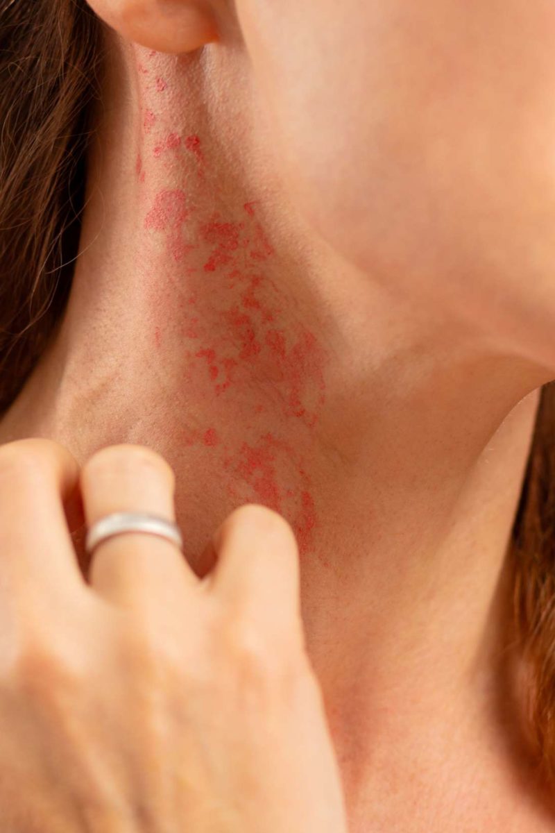 poison ivy rash on neck