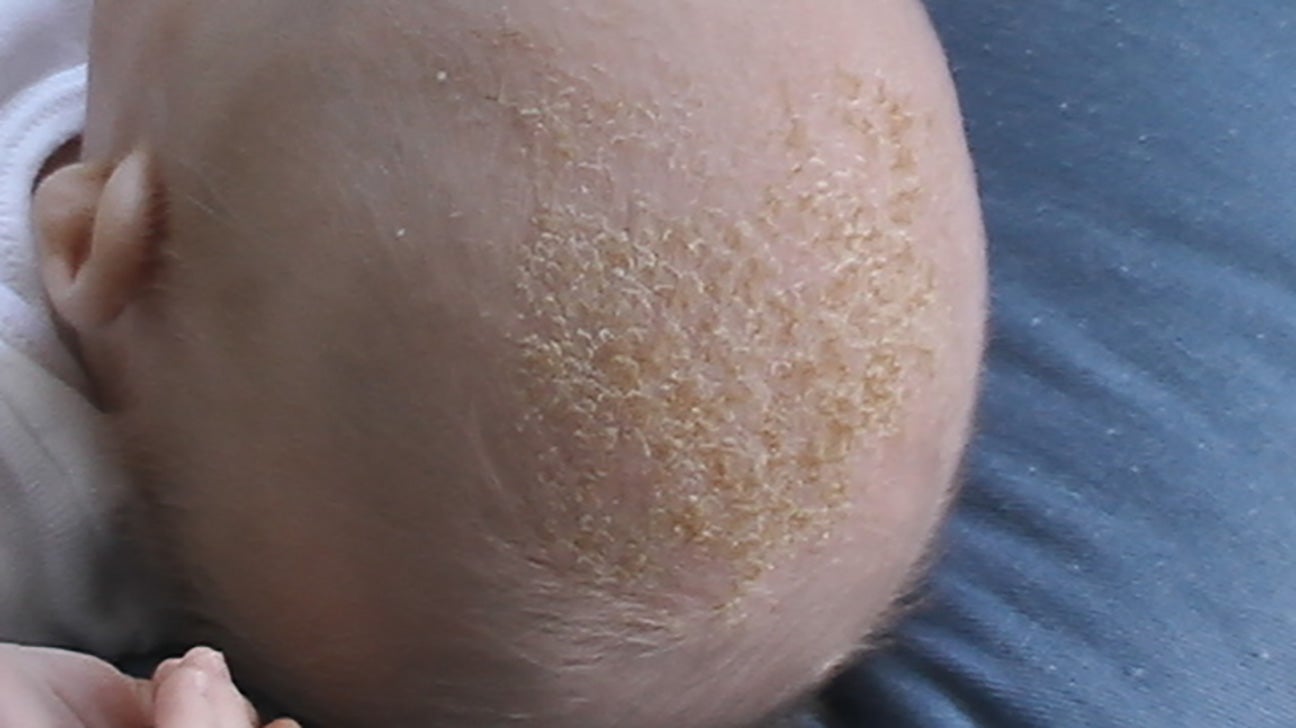 Fungal Rash On Face