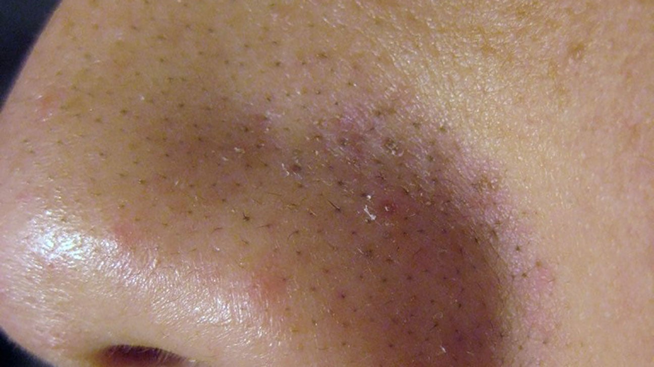 Sebaceous filaments look like blackheads, but they're different. 