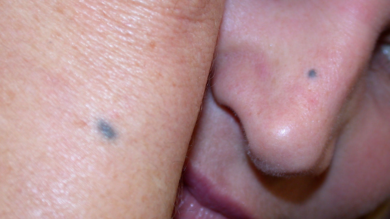 Blue Eyes Moles Face Light Skin Tone