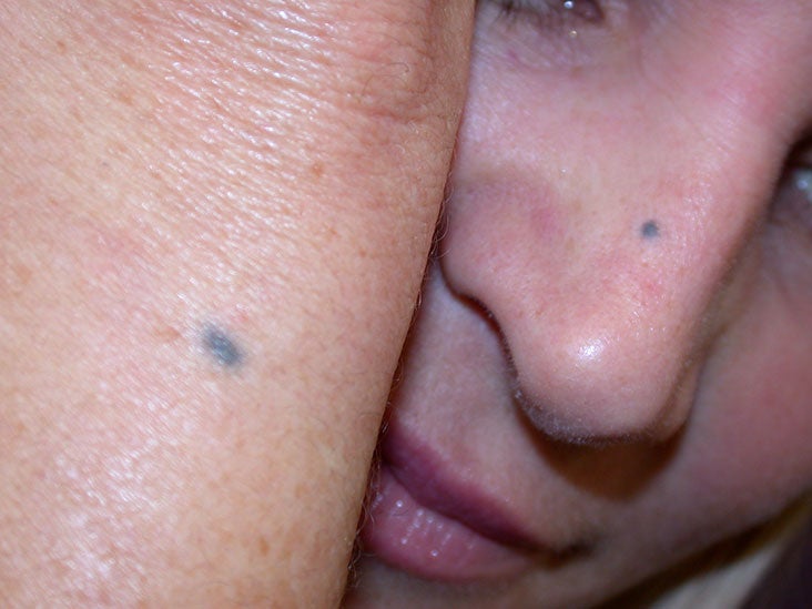 Blue nevus - Symptoms and causes - wide 4