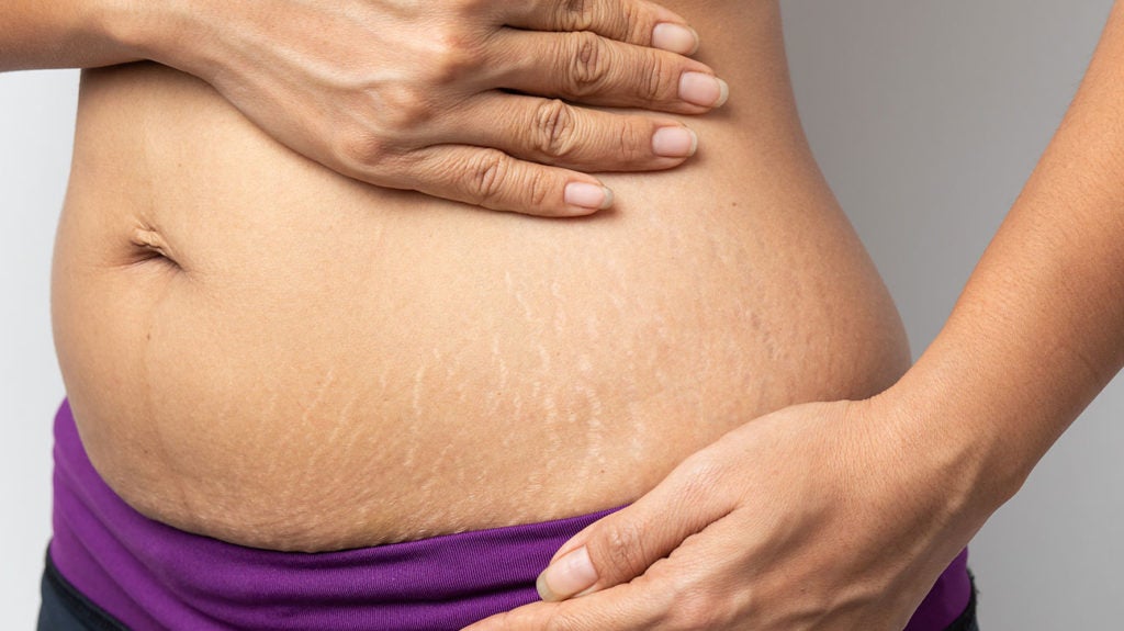 9 Natural Stretch Mark Treatments Backed by Science