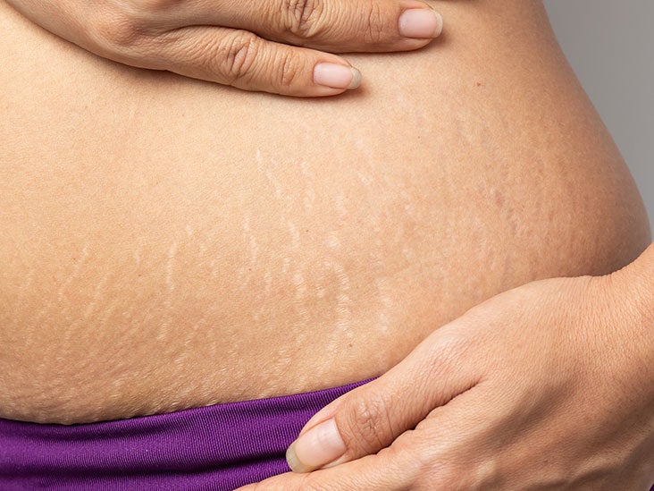 HOW TO COVER STRETCH MARKS ON ARMS WITH MAKEUP