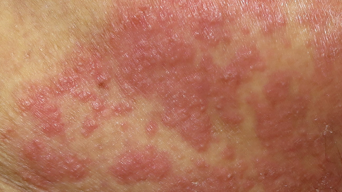 candidiasis of skin