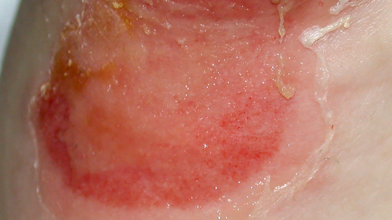 Bumps From Yeast Infection