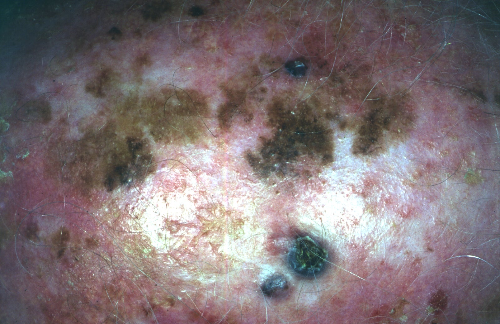 lentigo maligna melanoma