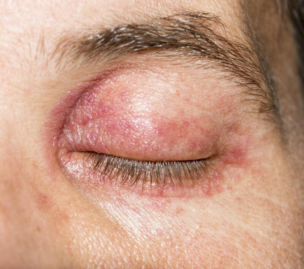 Eczema On Lower Eyelid At Sherry Baker Blog