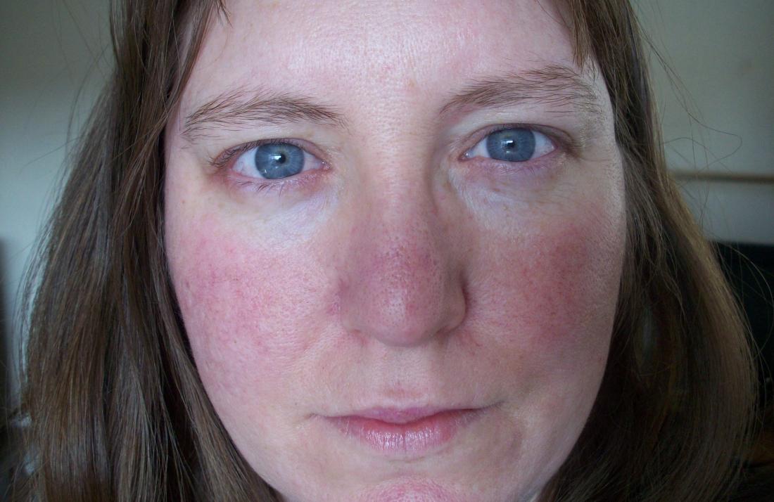 red-flushed-face-symptoms