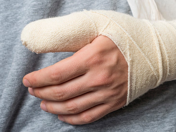 Broken Thumb Signs Symptoms And Treatment