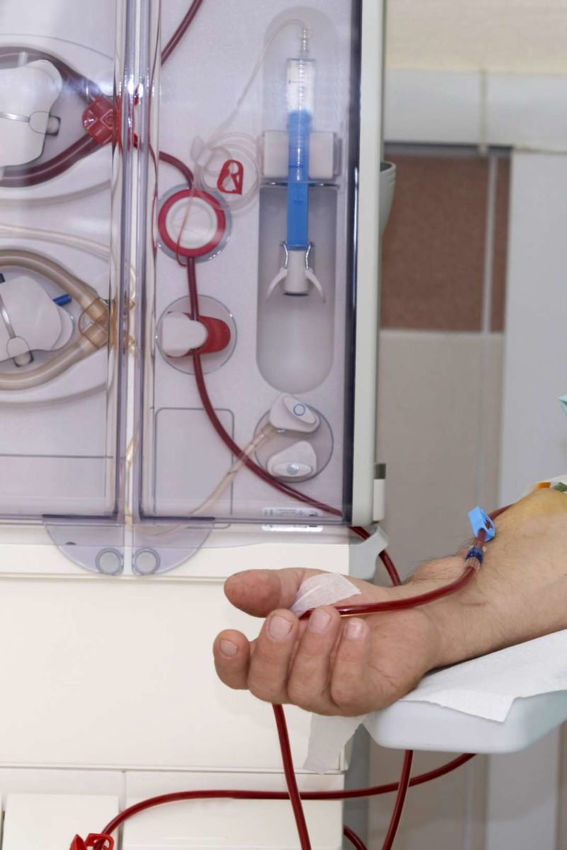 dialysis-procedure-purpose-types-side-effects-and-more