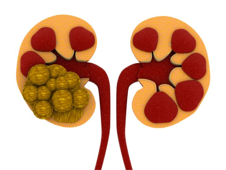 natural treatment for kidney stones