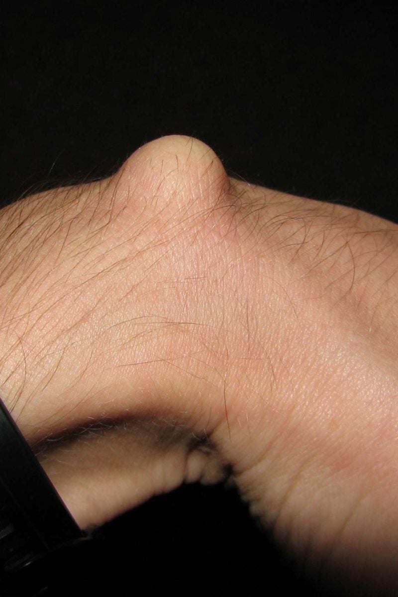 Can A Ganglion Cyst Be On A Finger