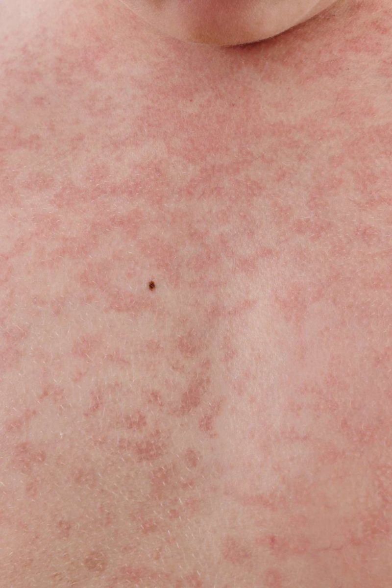 Rubella (German Measles): Symptoms, treatment, during pregnancy