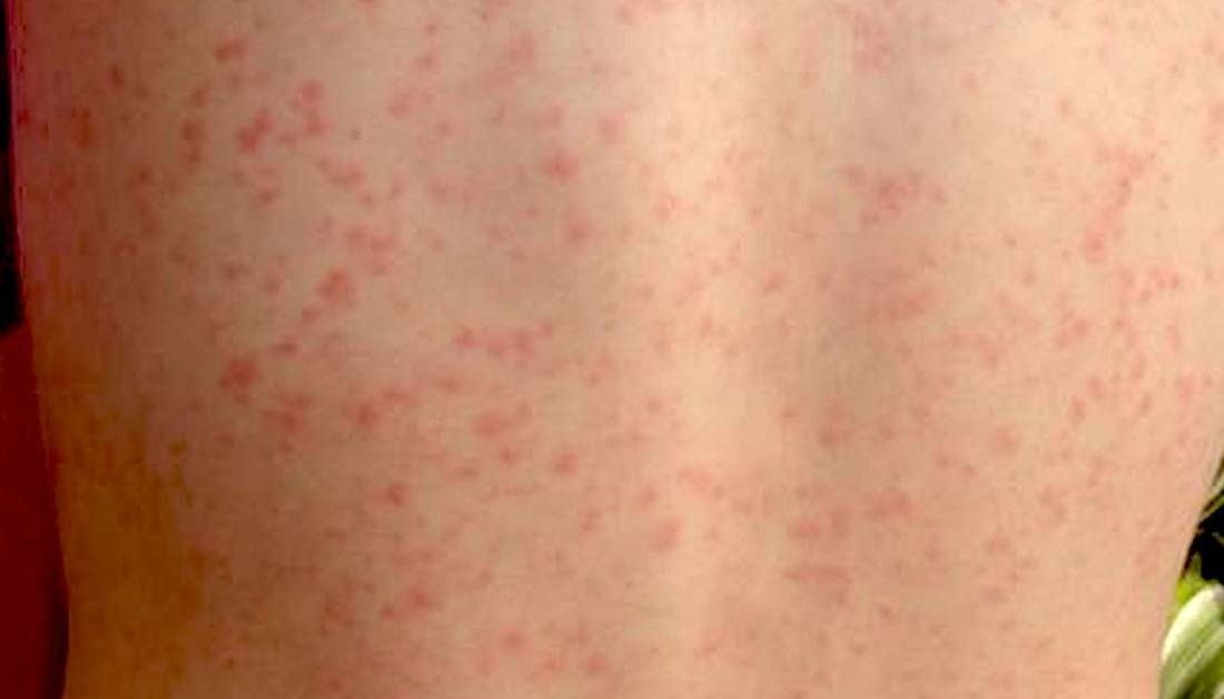 glandular-fever-rash-livestrong