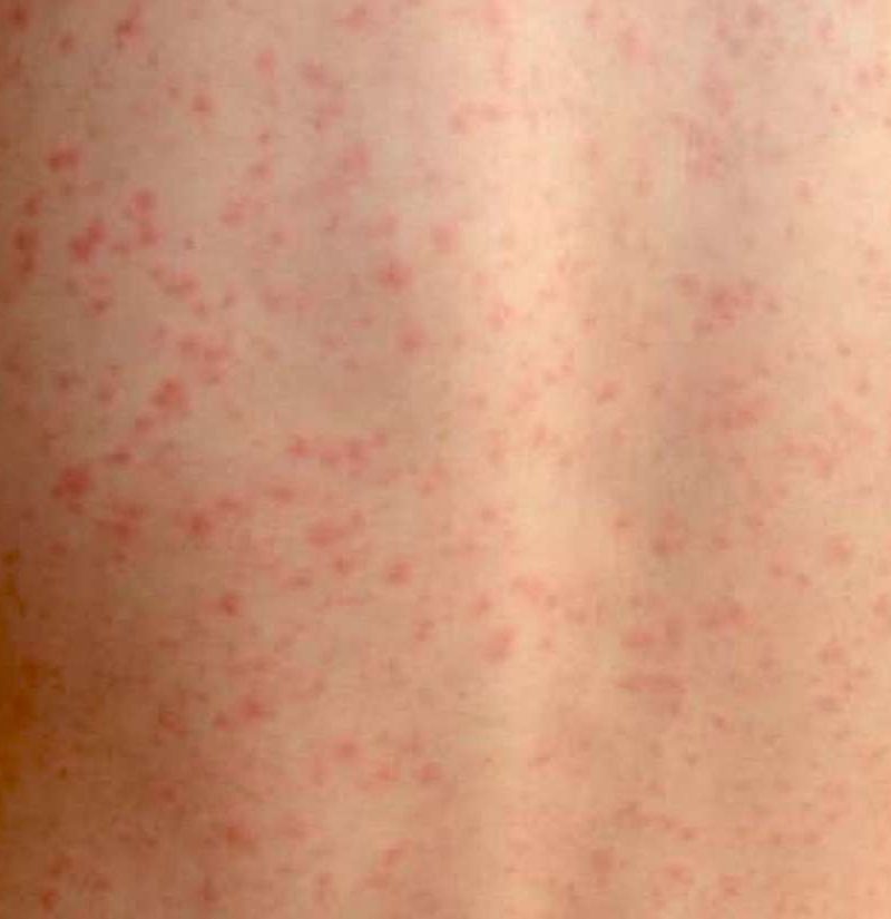 Scarlet fever Causes, symptoms, treatment, and complications