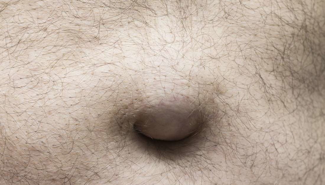 Umbilical Hernia Causes Symptoms And Treatments