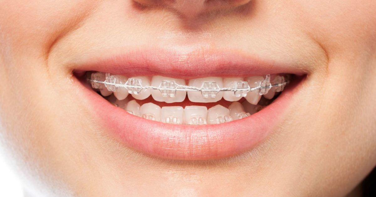 Orthodontics Maloccclusion other problems and starting treatment