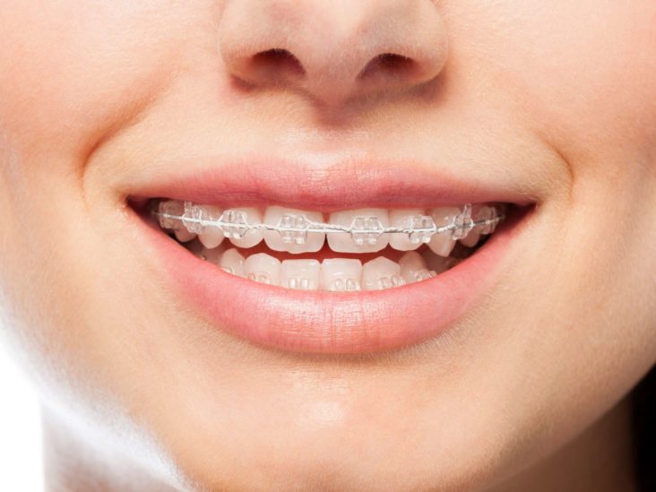 Do Braces Hurt What To Expect When You Get Braces