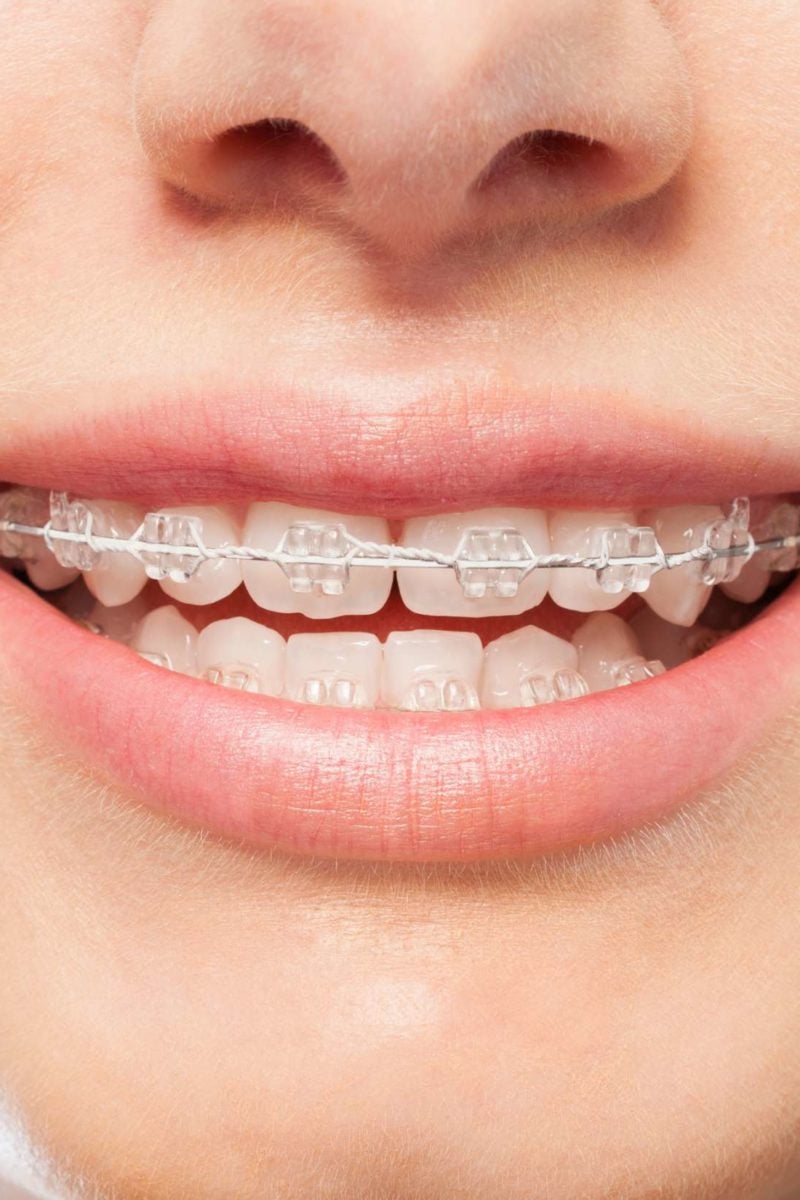 Can I Get Braces on Just My Top or Bottom Teeth?