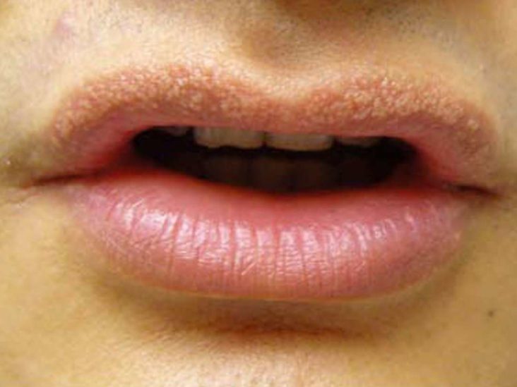 Can an allergic reaction cause bumps on lips