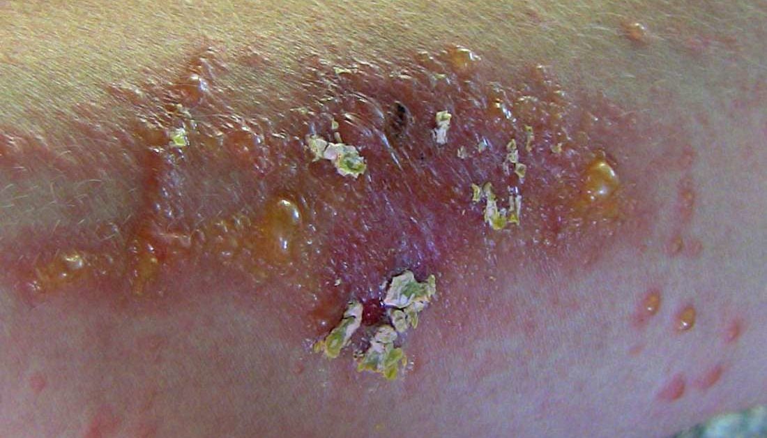 What Not To Do With Poison Ivy Rash