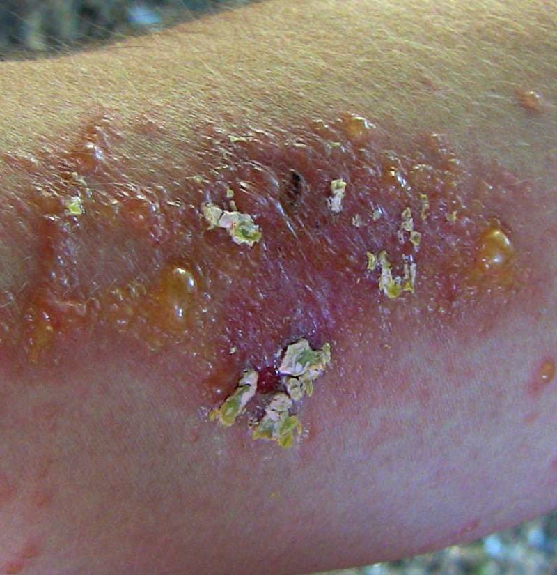 Poison Ivy Rash Causes Treatment And Prevention,Hummingbird Food Recipe