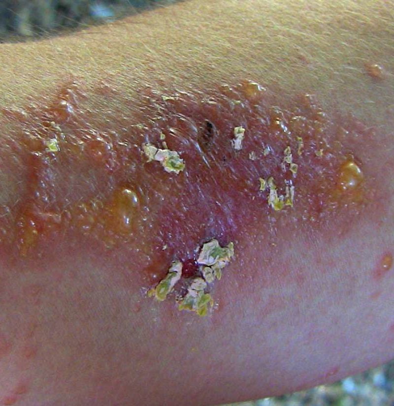 Different Types Of Poison Ivy On Skin