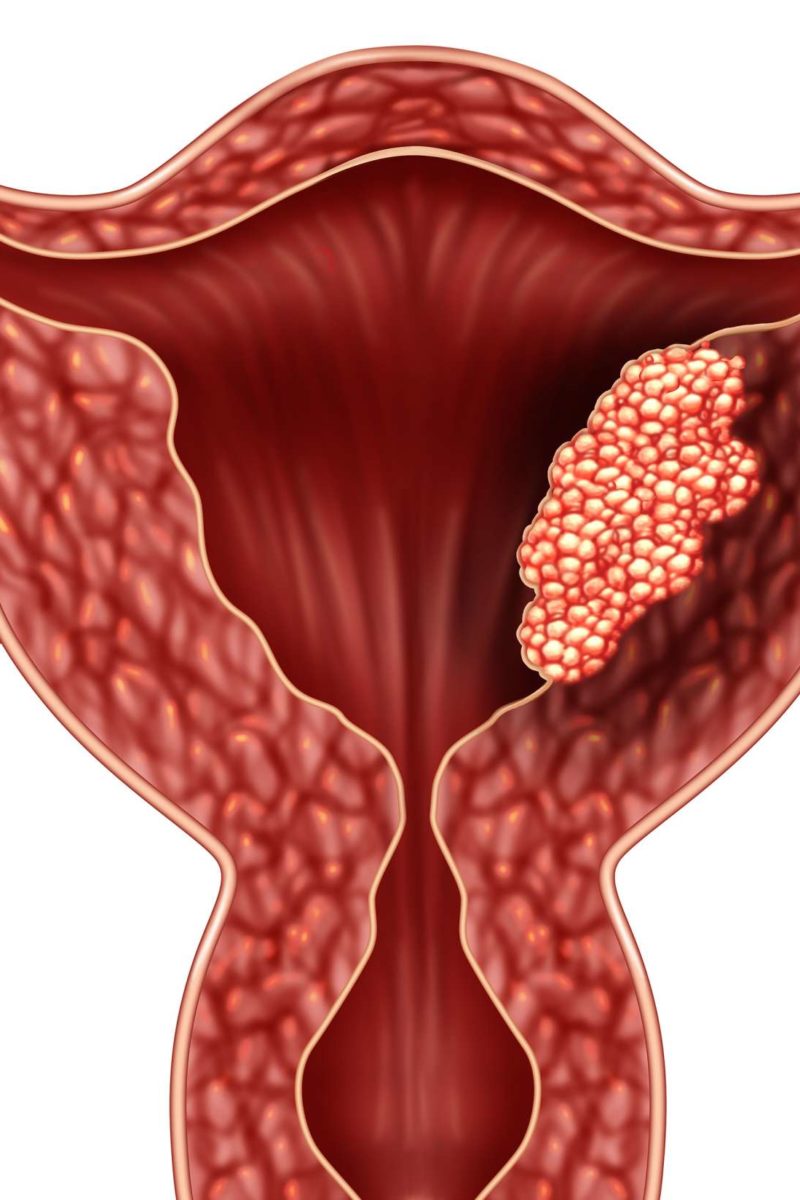 Endometrial Carcinoma 