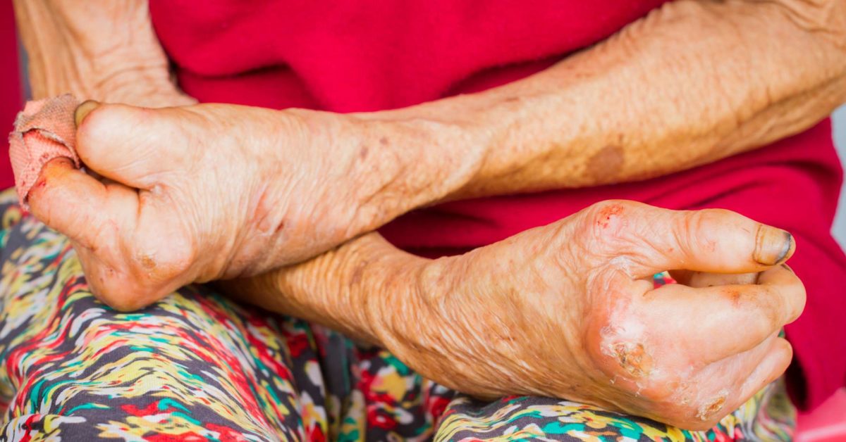 Leprosy (Hansen's disease): Symptoms, diagnosis, and treatment