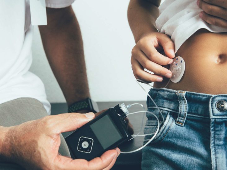 Type 1 Diabetes, Insulin Pump Therapy