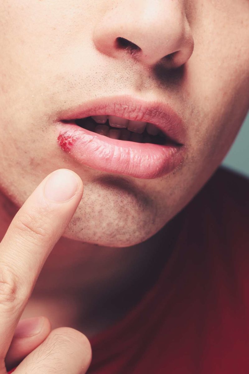 Cold Sores Around Period Time