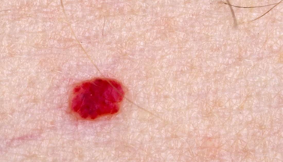 Blood Clot On Skin Surface