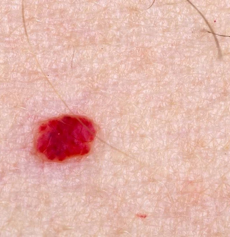 12 Mejores Imagenes De Hemangioma En 2020 Musculos Del Cuerpo Images