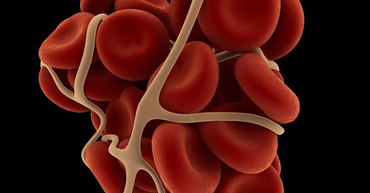 Signs Of Blood Clot After Surgery Eaglesdesign My XXX Hot Girl