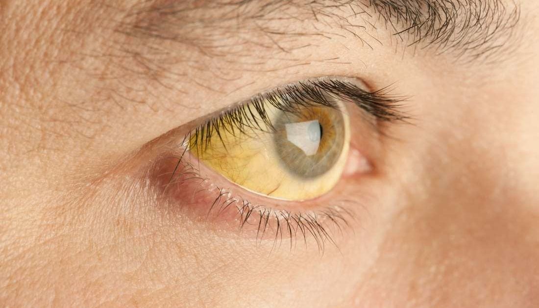 Yellow eyes: Causes in newborns, children, and adults